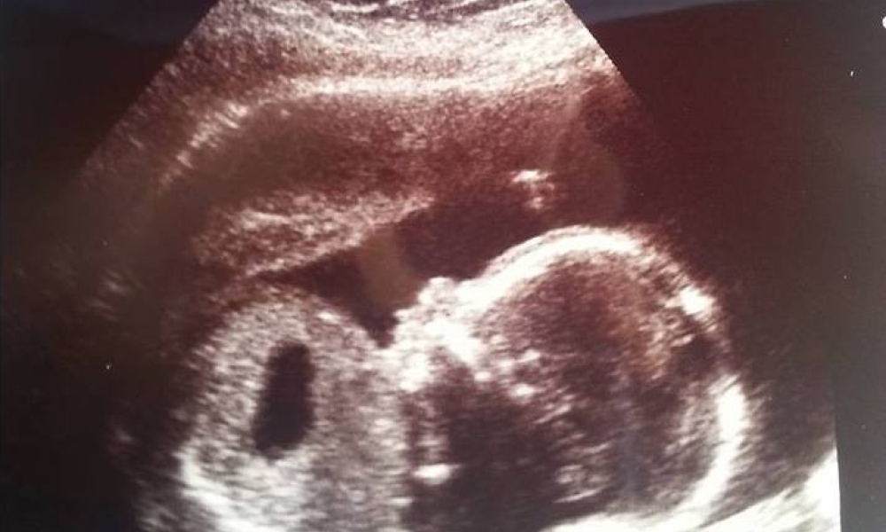 ultrasound
